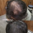 키키브라더스노원 | 종로3가 정수리 두피문신, '무경계 시술' 창시자는 다릅니다