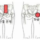 걸을때 갑자기 엉덩이 아픈거요 이미지