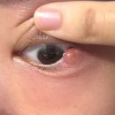 문정우리들 약국 | 6. 임산부 다래끼 치료 후기 / 다래끼 짜기 vs 다래끼 째기 / 문정역 안과 추천