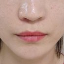 모아의원 | [수원 인계 팔자 필러 후기] 세모아의원에서 자연스럽게 리프팅된 내 얼굴!
