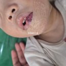 신정형외과의원 앞 | 아기 입술 찢어짐 부산 수의원 성형외과 주말야간 24시 응급봉합수술