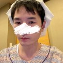 모발이식 하고왔습니다 ㄷㄷ모발이식 병원 선택 리얼 후기