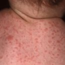 두드러기 (Urticaria) 이미지