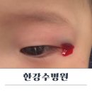 한강수병원 | 13개월 아기 눈옆 찢어짐 사고 한강수병원 봉합 후기