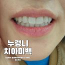 상아치과 | 누렁니 고민 해결 ! 강남 원데이치아미백치과 상담후기