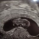 삼성서울여성의원 | 서울 비커밍여성의원 시험관1차 후기(5) 신선이식1차 성공, 난임병원졸업