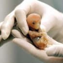 extrauterine gestation(자궁외임신) 이미지