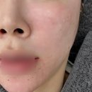 건조한피부 시술에 좋은 리쥬란힐러 효과시기 주기 통증 가격 후기