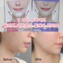 브이(V) | 로로스키니 하이드로겔 브이 리프팅팩(보라색) 후기 | 프리미엄 V마스크팩 (분홍색) 비교