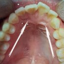 유재석치과의원 | 유재석 앞니 교정후기 (발치없는 빠른 교정) - 명동 한번에치과