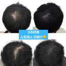 M-Cosmetic | 구미두피문신, 30대 직장인 정수리 탈모 SMP 후기 (도투)