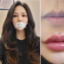 제안과의원 | # 화곡역 밴스 의원 _ 내돈내산 입술 필러 및 입꼬리 보톡스 이벤트 비용 실제 후기 일지 기록