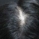 오마초등학교 | 고양탈모병원에서 리제네라액티바 받은지 2년 후기 (줄기세포 탈모치료 변화 과정)