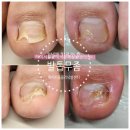 하이서울클리닉의원 | 김포 강화 검단 발톱무좀 군대 생활 힘들어요~[구래역]하이서울클리닉 치료 후기