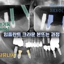 11590-다18 | 대구 본동 치과 , 임플란트 주위염 제거 후 재수술 사례