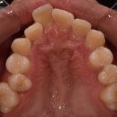 치성 부정교합[Dental malocclusion] 이미지