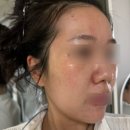 서울엔비뇨기과의원 | 힐비뇨기과 잡티제거 솔직후기｜7개월 경과 변화 &amp; 부작용까지 솔직 리뷰