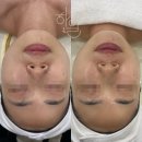 백점수학교습소 | [대구/수성구청역] 하일리에스테틱에서 v2라인관리 받고 v라인 된 후기.