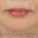 아틀리에성형외과의원 | 입필 맛집! 입술필러는 아틀리에 성형외과!