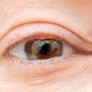 눈 다래끼 나는 이유와 원인 초기 증상 치료 약물 전염 : 겉 속 콩 다래끼 이미지