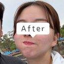 예다안스킨케어 | 천안 여드름관리 잘하는 곳｜이정희스킨케어 아사필링 리얼후기