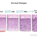 자궁경부이형성증 증상 및 원인, 치료 (자궁이형성증, 원추절제술, 1단계, 2단계, 3단계) 이미지