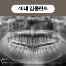 온리원 | 발안치과 온리원 40대 임플란트 시술과정 후기