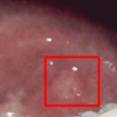 신가정의학과의원 | 설염 때문에 엄청 고생한 후기(결국은 병원에 가자, 그럼 알보칠을)