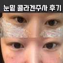미희네 | 연신내 피부과 미희주사 내돈내산 콜라겐주사 후기 눈밑꺼짐 효과