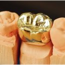 이다움치과의원 | 크라운 종류 차이점 총정리