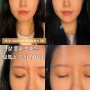 중앙로 권혁칠피부과 앞 | 대구보톡스추천 부작용 없이 제대로 맞는 법 (미간+자갈턱+사각턱)