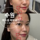 호호약국 | [수원역] 여드름 흉터 치료 수원 여드름 피부과 방문 후기 3탄!!