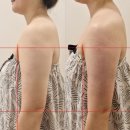 (주)폴라리스 | 잠실피부관리 폴라리스에스테틱 드레스라인과 팔뚝살 효과있는 드레스핏 4회차 후기