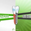 임플란티아