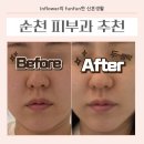 올리지오플라워 | 순천피부과추천 ｜ 라하필&씨엘로리프팅 ｜ 솔직후기