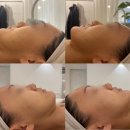 어 웨이브 A | 얼굴이 길어 보이는 30대 여성, 대구 중안부 리프팅 관리로 탄력 살렸어요 (써마웨이브 온다리팅 후기)