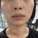김포 풍무 김포삼성의원 (편평사마귀 + 점 레이저 제거)내돈내산 후기🕶️