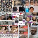 메트로팰리스2차B동 | 탈모 모발이식이 최선 일까요