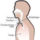 기관절개술[tracheostomy] 이미지