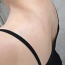 하이힐 | 강남 승모근보톡스 잘하는곳에서 받아 본 승모근 하이힐주사 후기