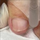 레푸스인하대역점 내성발톱 무좀발톱 발각질 문제성발 이미지