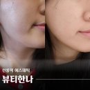 [선릉역 에스테틱] 뷰티한나 원더스몰토탈케어+미백 플라즈마 피부관리 후기
