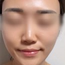 흔적 | 자외선에 진해진 트러블 흔적, 3개월 만에 달라졌어요｜셀라딕스 트리플 레티놀 흔적 앰플 후기
