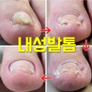 답십리네일하랑, 파고드는 문제성 내성발톱관리 후기