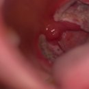 잠보호텔 | 아프지마 도토 도토 잠보_편도절제 수술 후기 (2)