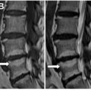 The pathophysiology of disc degeneration 그리고 biology of disc 이미지