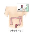 대장 내시경 검사(Colonoscopy) 이미지