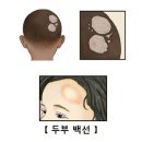 두부 백선(Tinea Capitis) 감염성 질환, 피부질환이란? 이미지