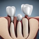 서울슬기로운치과의원 | 서울 영등포구 임플란트 치과 잘하는 곳, 가격 비용 싼 곳 BEST10 추천