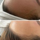 용인<b>스킨</b>플래닝 묵은각질 피지 걱정끝!